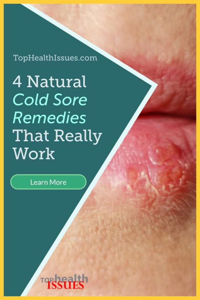 4 Natural Cold Sore Remedies That Really Work