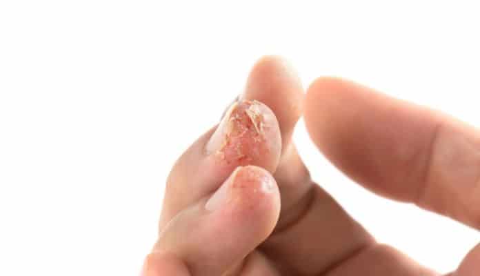 Dry and cracking skin on finger