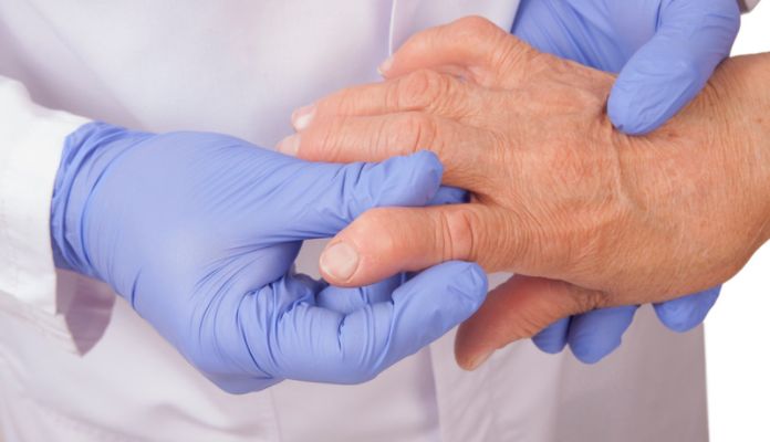 Hand with Rheumatoid Arthritis