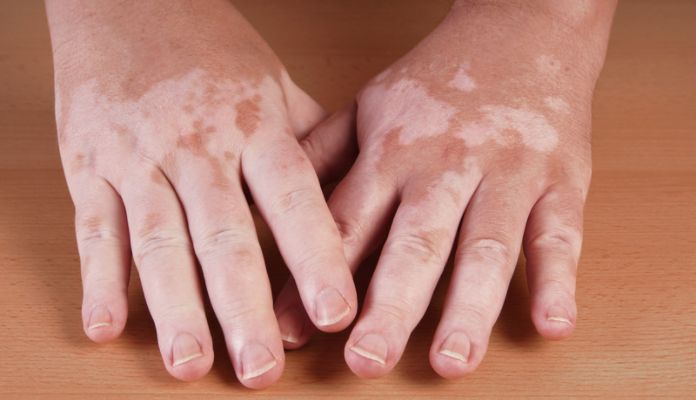 Pai of hands with autoimmune disorder